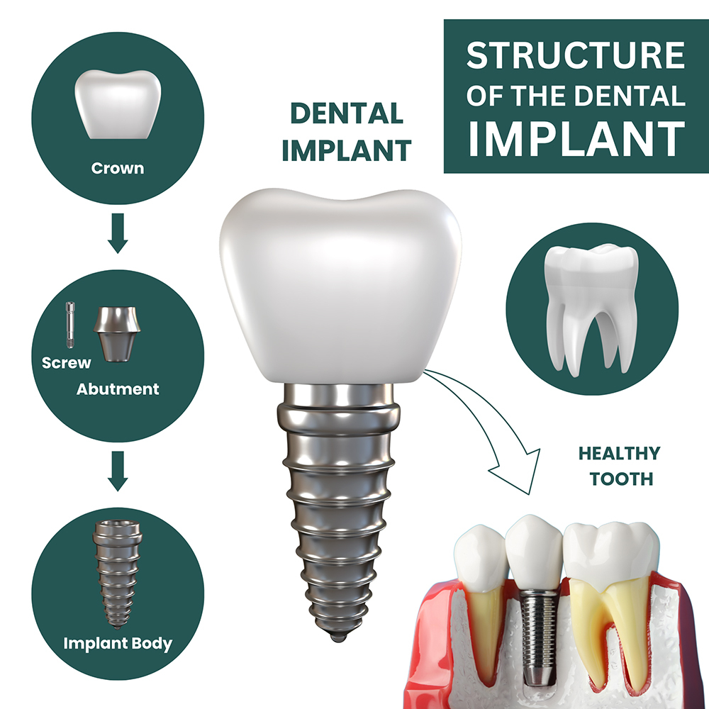 dental implant structure