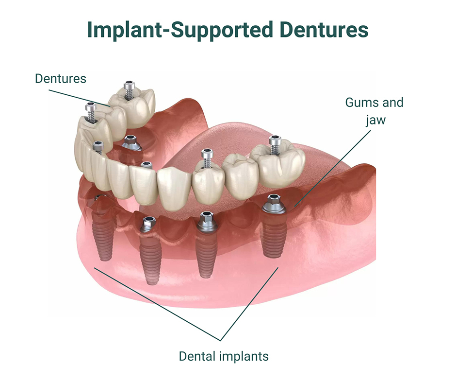 implant supported dentures 