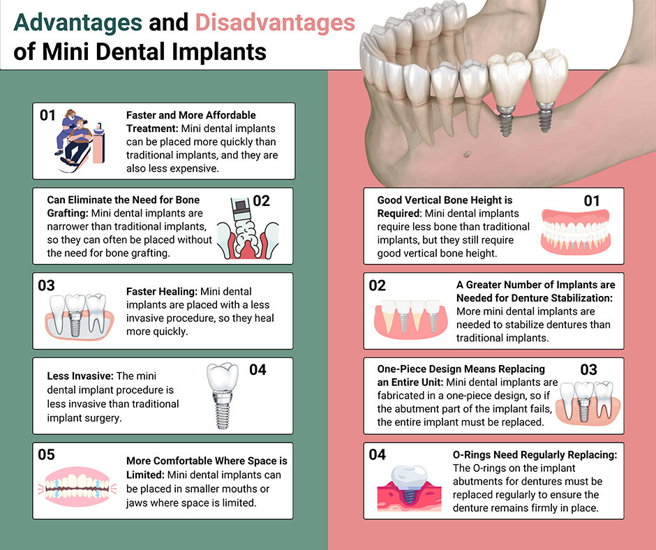 Advantages and Disadvantages of Using Mini Dental Implants