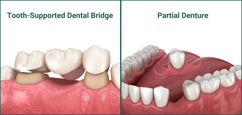 alternatives to a front tooth implant