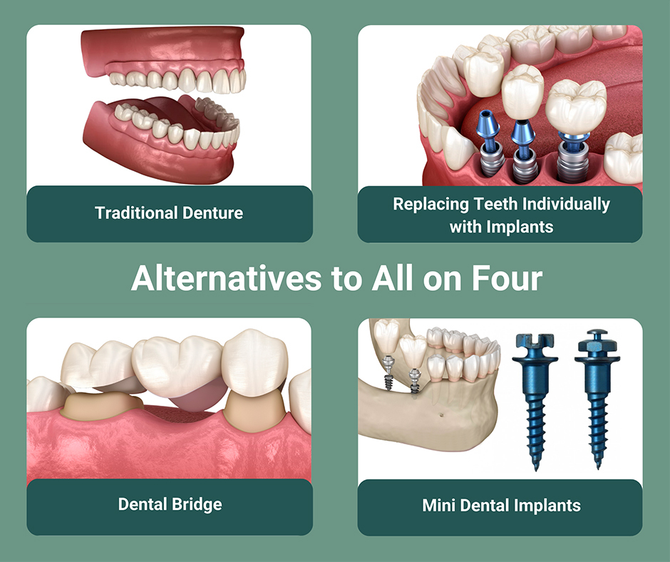 Alternatives to All on Four Dental Implants