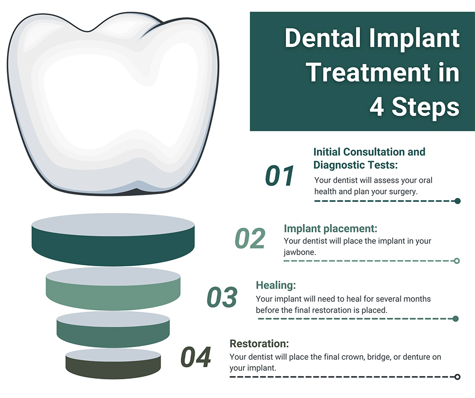 Dental Implant Treatment in 4 Steps