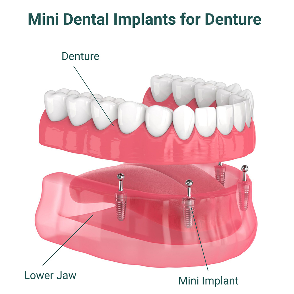 Over-Denture O-Ring and Locator Replacement Service | Denture Repair Lab