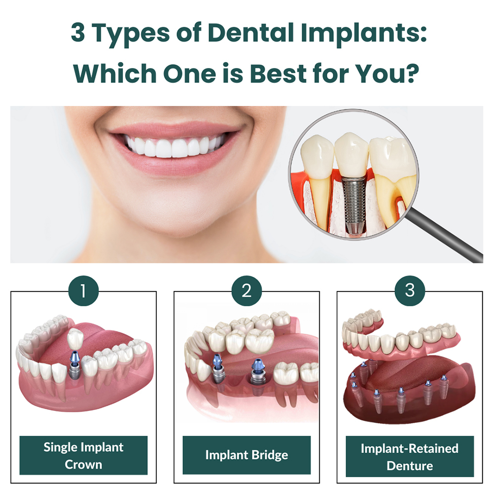 3 Types of Dental Implants: Which One is Best for You