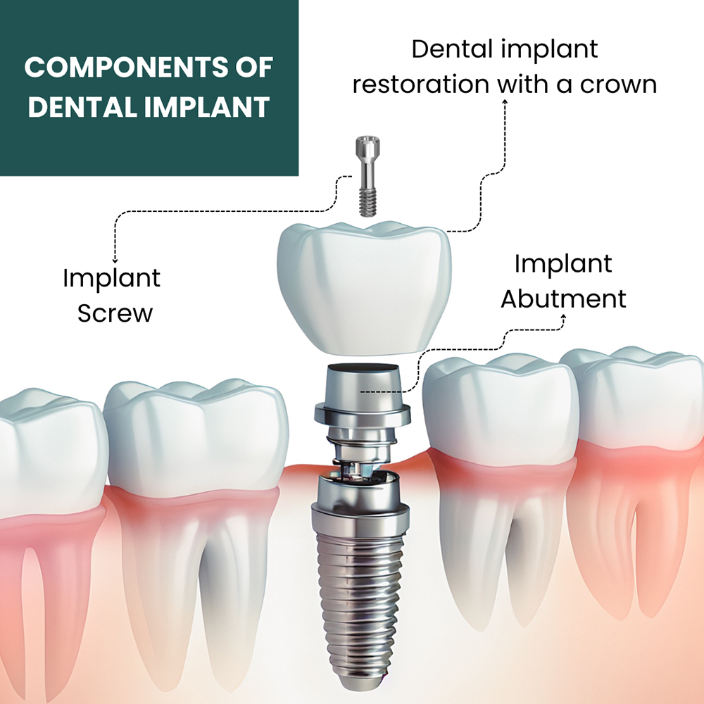 Components of Dental Implant