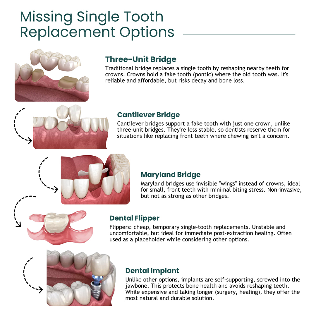 Missing Single Tooth Replacement Options