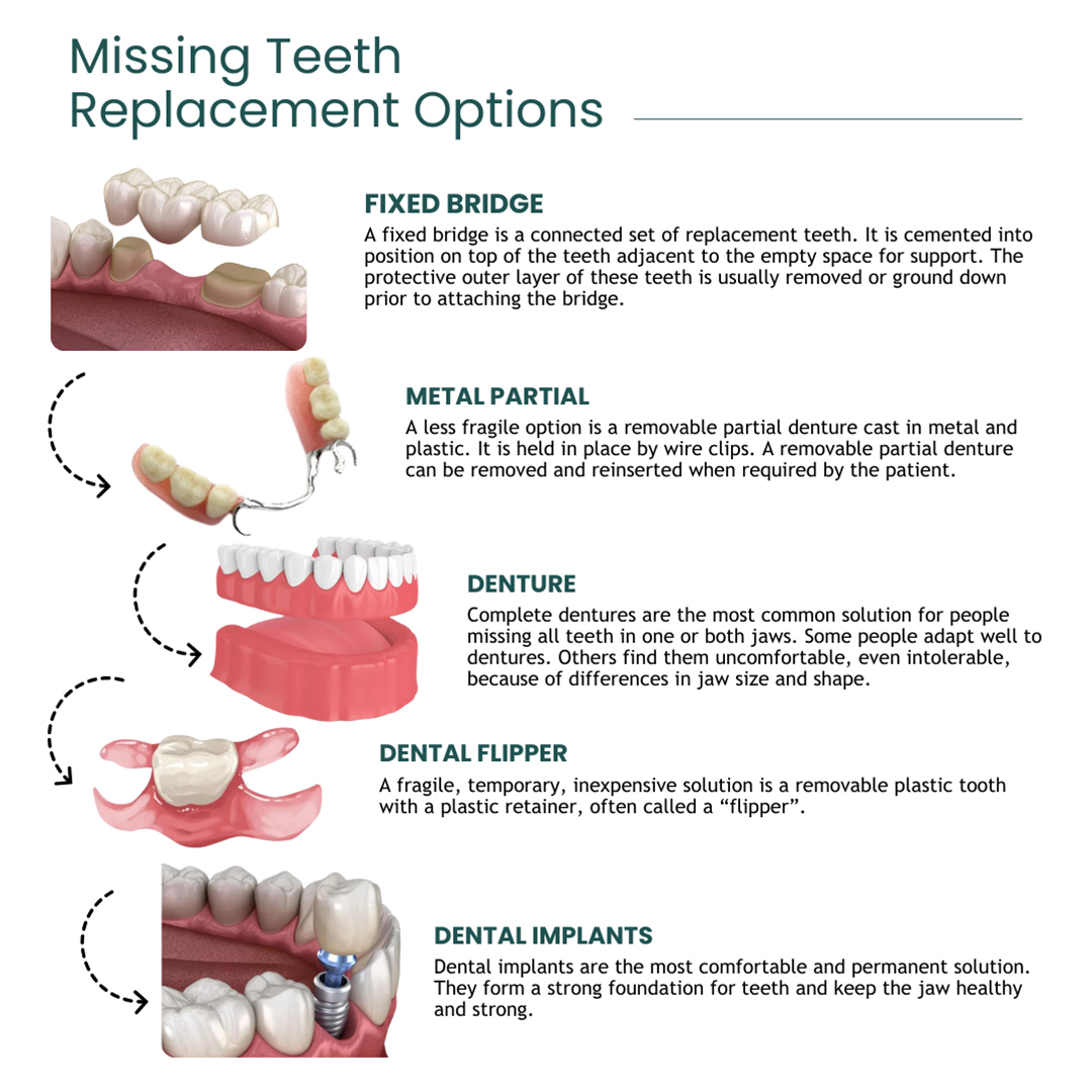 Missing Teeth Replacement Options