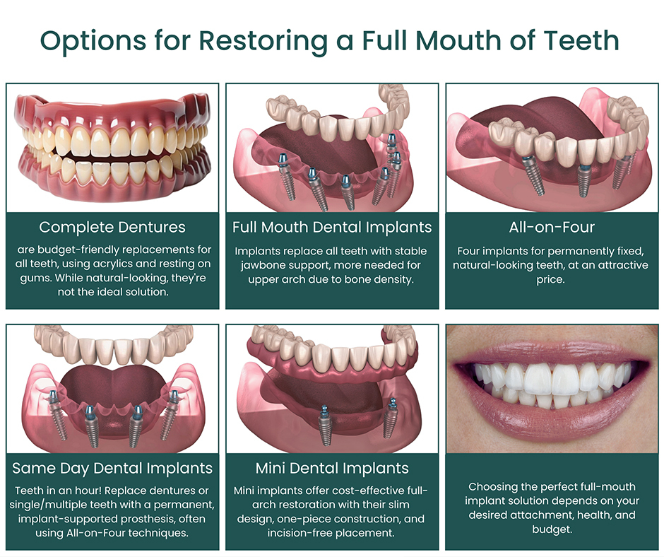 Options for Restoring a Full Mouth of Teeth