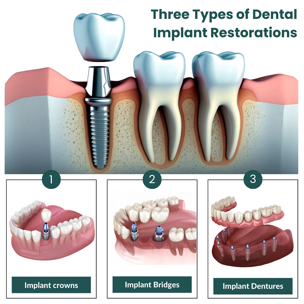 Three Types of Dental Implant Restorations