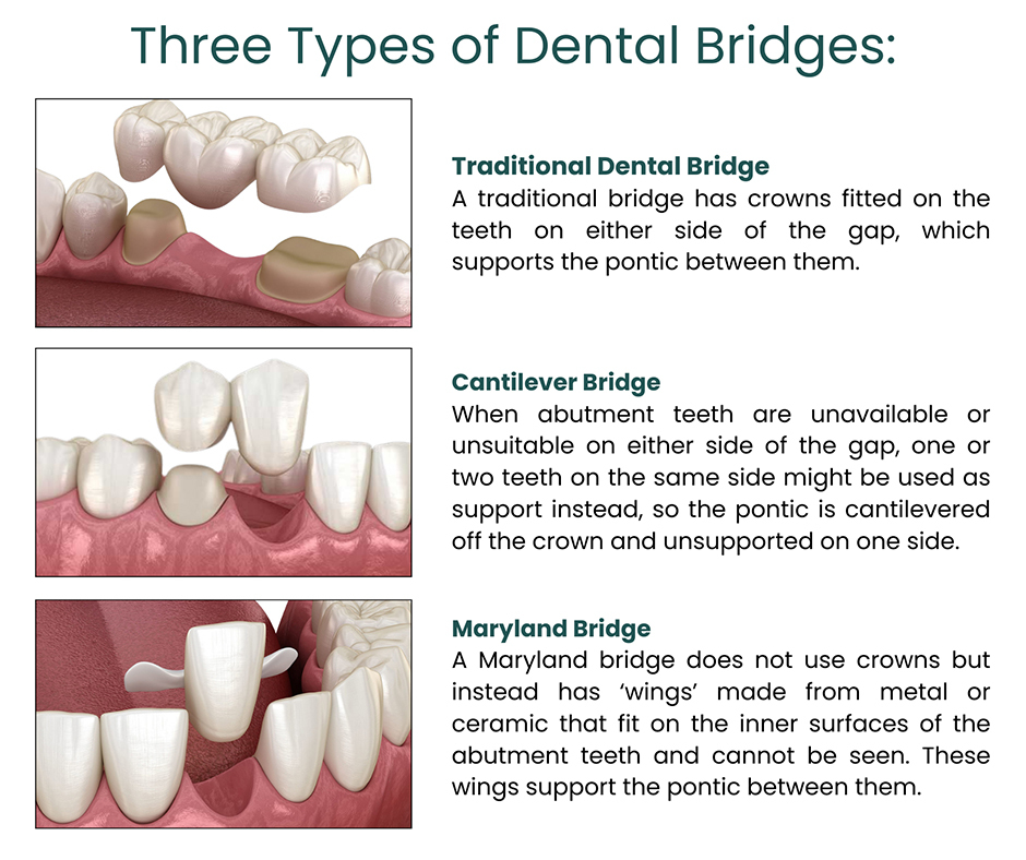 Types of Dental Dridges