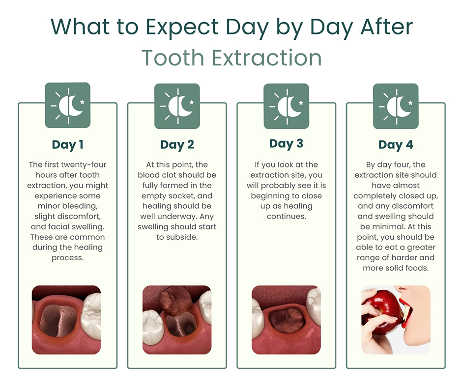 What to Expect Day by Day After Tooth Extraction